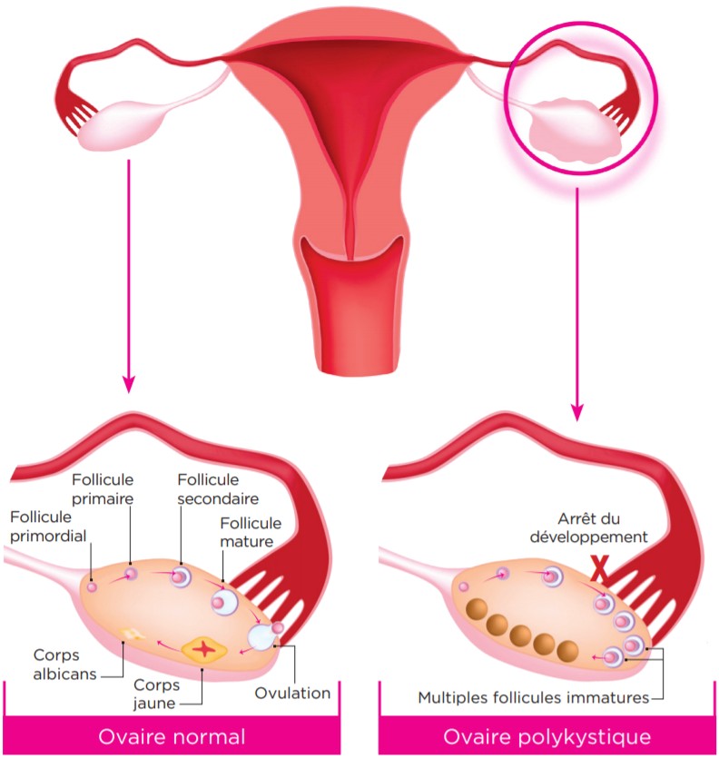 Syndrome polykystique ovarien SOPK : symptômes et prise en charge - Physio  Sahifa