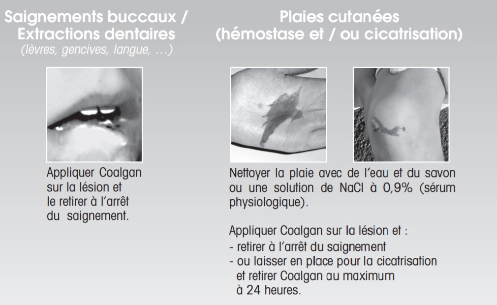 BROTHIER COALGAN MECHES 4cm Bte/5 - Mèches Hémostastique Stérile