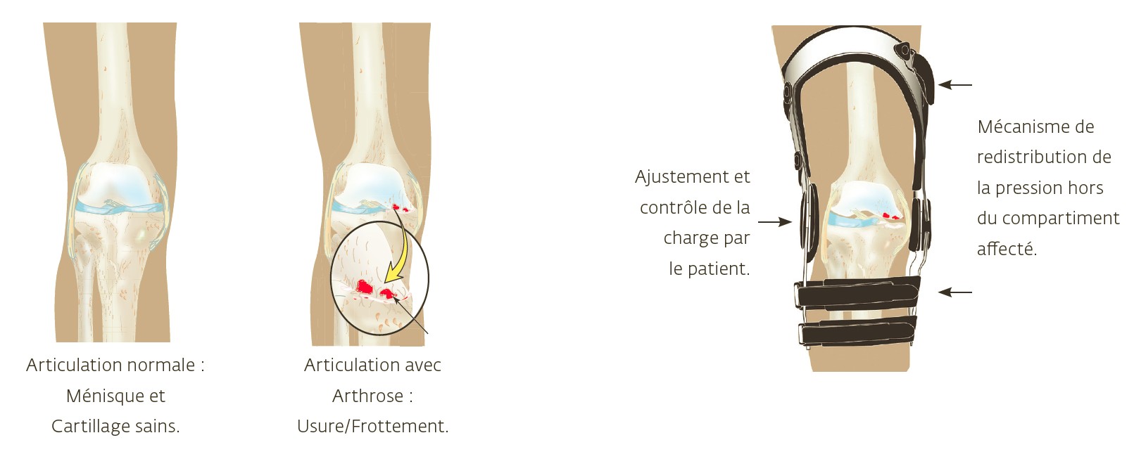 Attelle de gonarthrose OA FullForce Donjoy - Medical Domicile