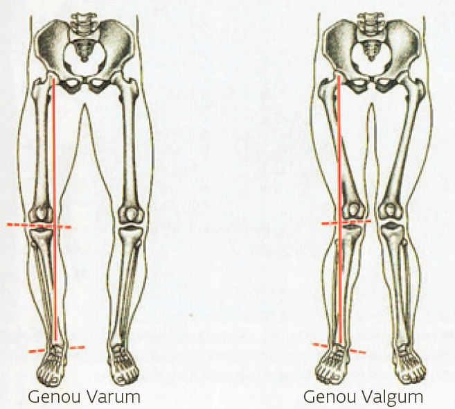 Genouillère gonarthrose Clima-Flex OA DONJOY