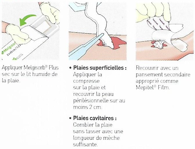 MÖLNLYCKE MELGISORB Plus 10 x 12 cm - Pansement d' Alginate Mèche ...