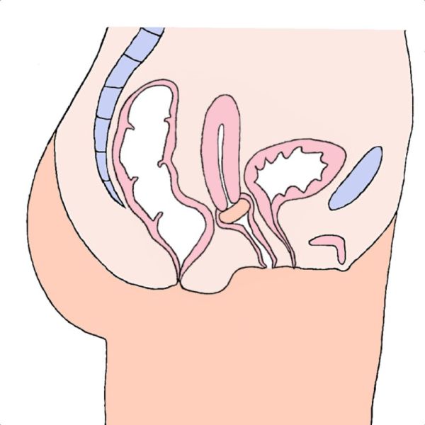 MILEX Pessaire DONUT Ø83mm Taille 5 - Prolapsus Génital Stade 3 et 4, Incontinence