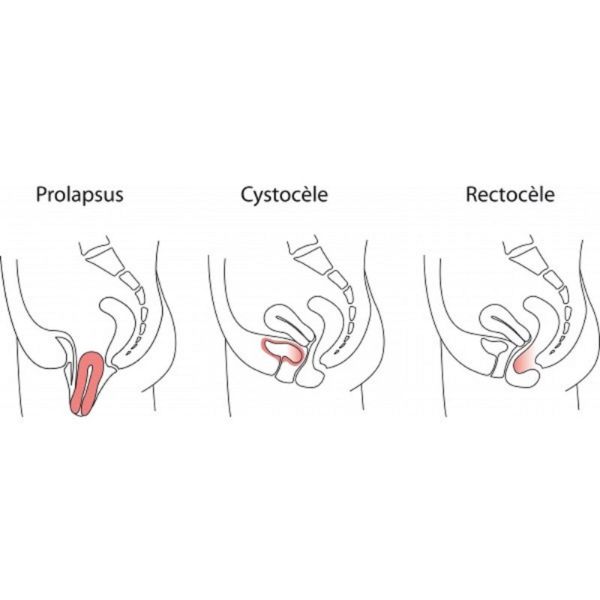 PESSAIRE Gyn et Cube Standard 28 x 38mm en Silicone, Orifices de Drainage - Prolapsus Utérin - Bte/1