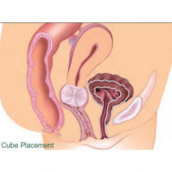 GYNEAS Pessaire Gyn et Cubic Ø74mm Taille 10 - Prolapsus Utérin Stade 3, Cystocèle, Rectocèle