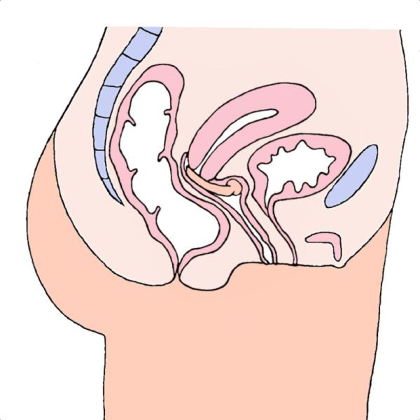 MILEX Pessaire DISH Uretral Ø85mm Taille 6 - Incontinence Accompagné d' un Prolapsus