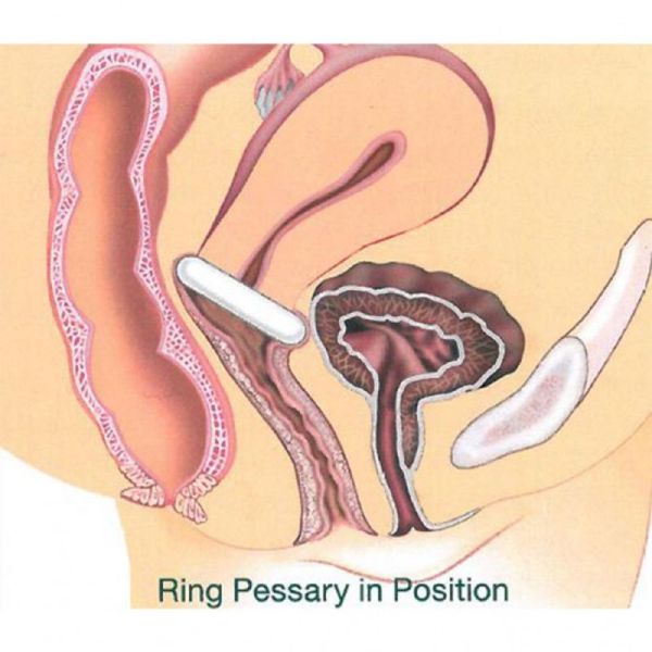 GYNEAS Pessaire Gyn et Ring Silicone Ø74mm Taille 5 - Prolapsus Utérin Stade 1, Cystocèle