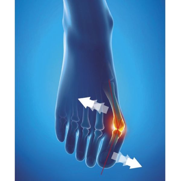 EPITACT Orthèse de Nuit Taille M (Médium) Hallux Valgus Thermoformable, Corrective, Unilatérale