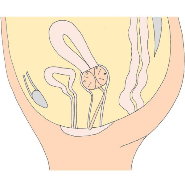 MILEX Pessaire CUBE Perforé Ø44mm Taille 5 - Tous les Prolapsus Génitaux, Incontinence