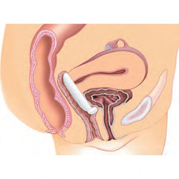 GYNEAS Pessaire Gyn et Dish Ø63mm Taille 3 - Prolapsus Utérin Stade 1 et 2, Cystocèle, Incontinence