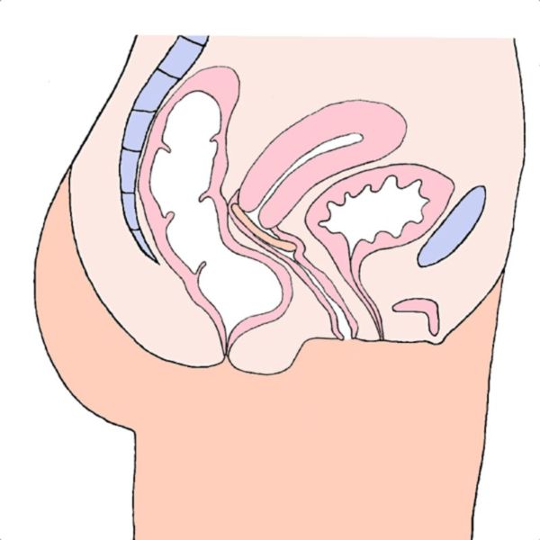 MILEX Pessaire ANNEAU AVEC SUPPORT Pliable Ø70mm Taille 4 - Prolapsus Génital Vessie, Utérus - 1 Unité