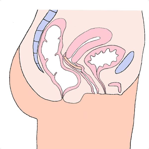 MILEX Pessaire ANNEAU Pliable Ø95mm Taille 8 - Prolapsus Génital Vessie, Utérus - 1 Unité