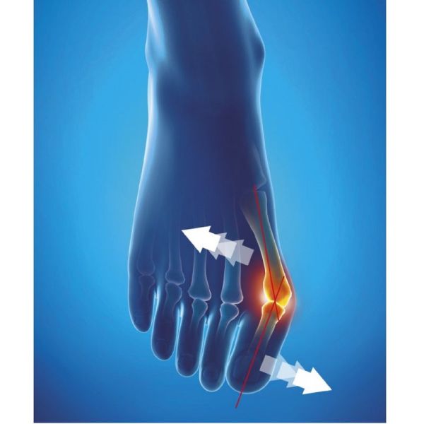 EPITACT Orthèse Corrective Souple JOUR pour Hallux Valgus S (small) - Epithelium Flex - Bte/1